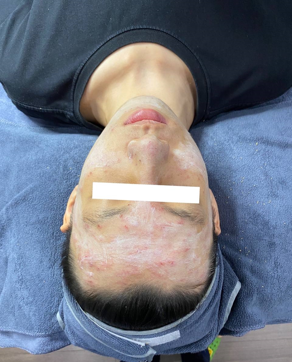 ANH MAI skinlab trị mụn chuẩn y khoa
