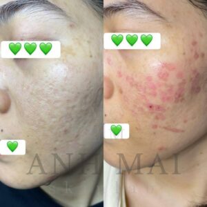 H&igrave;nh ảnh Thực Tế Before - After Sẹo - ANH MAI Skinlab - Trị Mụn V&agrave; Sẹo Rỗ Chuẩn Y Khoa Dĩ An