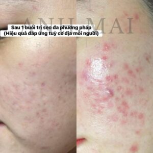 H&igrave;nh ảnh thực tế Before – After Sẹo