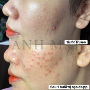 H&igrave;nh ảnh thực tế Before – After Sẹo