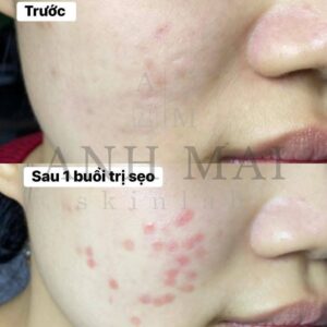 H&igrave;nh ảnh thực tế Before – After Sẹo