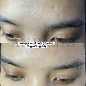 H&igrave;nh ảnh thực tế Before – After Sẹo