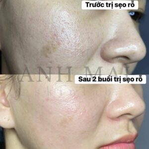 H&igrave;nh ảnh thực tế Before – After Sẹo