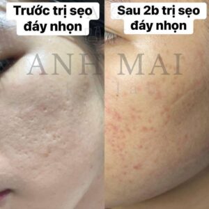 H&igrave;nh ảnh thực tế Before – After Sẹo