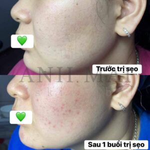 H&igrave;nh ảnh thực tế Before – After Sẹo