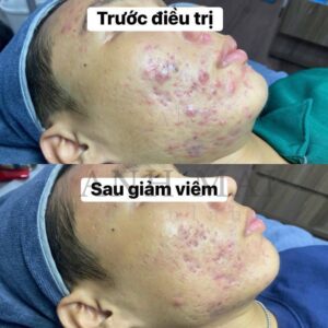 H&igrave;nh ảnh hiệu quả trước v&agrave; sau điều trị mụn vi&ecirc;m nặng tại ANH MAI Skinlab - Trị Mụn V&agrave; Sẹo Rỗ Chuẩn Y Khoa Dĩ An