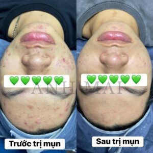 H&igrave;nh ảnh thực tế Before – After Mụn