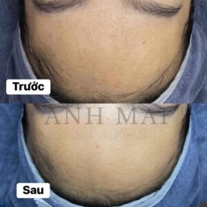 H&igrave;nh ảnh thực tế Before – After Mụn