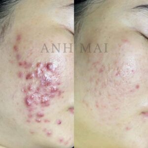 H&igrave;nh ảnh thực tế Before – After Mụn