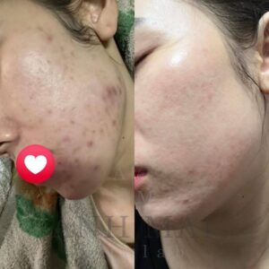 H&igrave;nh ảnh thực tế Before – After Mụn