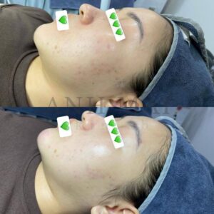 H&igrave;nh ảnh thực tế Before – After Th&acirc;m S&aacute;ng Da