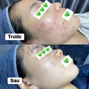 H&igrave;nh ảnh thực tế Before – After Th&acirc;m S&aacute;ng Da