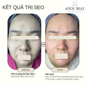 H&igrave;nh ảnh thực tế Before – After Sẹo