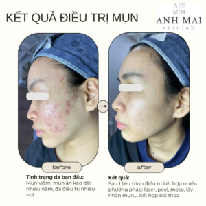 H&igrave;nh ảnh thực tế Before – After Mụn