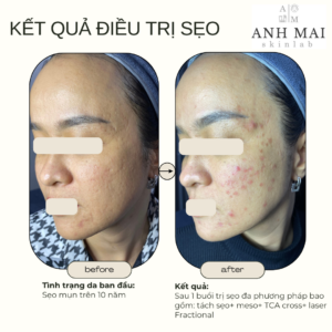 H&igrave;nh ảnh thực tế Before – After Sẹo