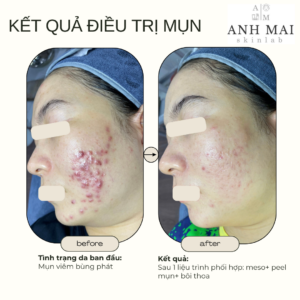 H&igrave;nh ảnh thực tế Before – After Mụn