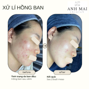 H&igrave;nh ảnh thực tế Before – After Th&acirc;m S&aacute;ng Da