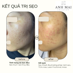 H&igrave;nh ảnh thực tế Before – After Sẹo