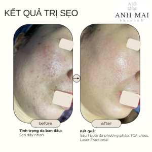 H&igrave;nh ảnh thực tế Before – After Sẹo