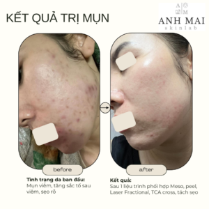 H&igrave;nh ảnh thực tế Before – After Mụn