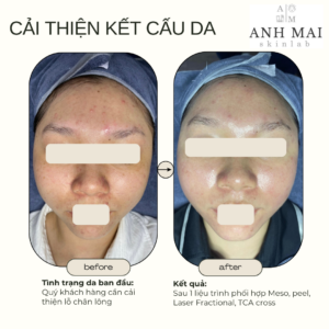 H&igrave;nh ảnh thực tế Before – After Sẹo