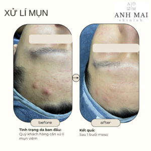H&igrave;nh ảnh thực tế Before – After Mụn