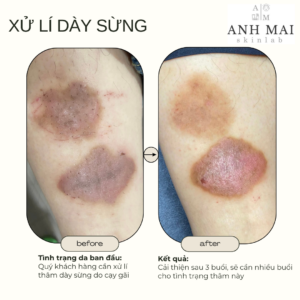 H&igrave;nh ảnh thực tế Before – After Th&acirc;m S&aacute;ng Da