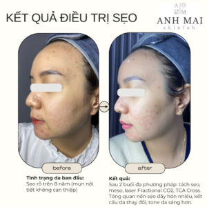 H&igrave;nh ảnh thực tế Before – After Sẹo
