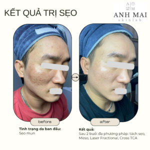 H&igrave;nh ảnh thực tế Before – After Sẹo