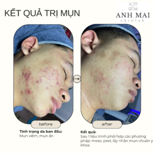 H&igrave;nh ảnh thực tế Before – After Mụn