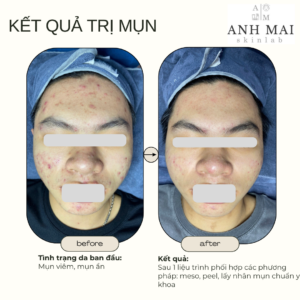 H&igrave;nh ảnh thực tế Before – After Mụn