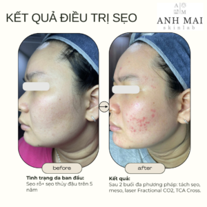 H&igrave;nh ảnh thực tế Before – After Sẹo