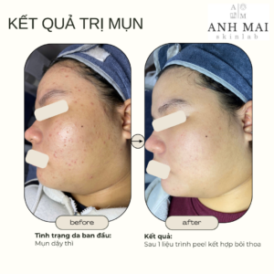H&igrave;nh ảnh thực tế Before – After Mụn