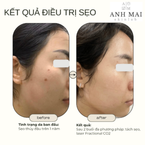 H&igrave;nh ảnh thực tế Before – After Sẹo
