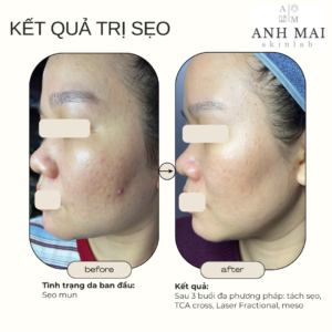 H&igrave;nh ảnh thực tế Before – After Sẹo