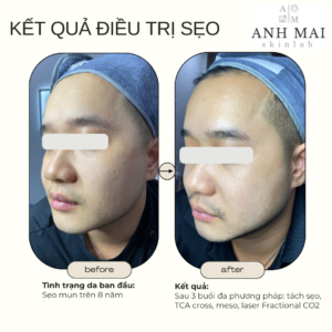 H&igrave;nh ảnh thực tế Before – After Sẹo