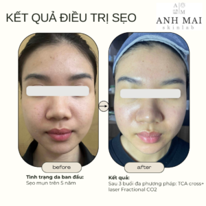 H&igrave;nh ảnh thực tế Before – After Sẹo