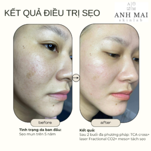 H&igrave;nh ảnh thực tế Before – After Sẹo