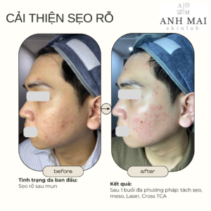 H&igrave;nh ảnh thực tế Before – After Sẹo