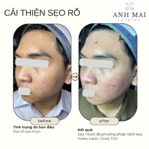 H&igrave;nh ảnh thực tế Before – After Sẹo