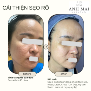 H&igrave;nh ảnh thực tế Before – After Sẹo