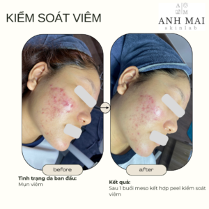 H&igrave;nh ảnh thực tế Before – After Mụn