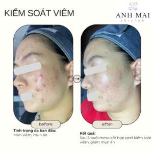 H&igrave;nh ảnh thực tế Before – After Mụn