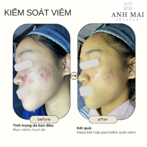 H&igrave;nh ảnh thực tế Before – After Mụn