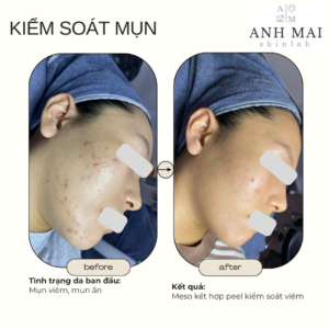 H&igrave;nh ảnh thực tế Before – After Mụn