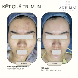 H&igrave;nh ảnh thực tế Before – After Mụn