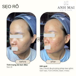 H&igrave;nh ảnh thực tế Before – After Sẹo