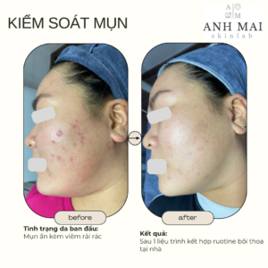 H&igrave;nh ảnh thực tế Before – After Mụn