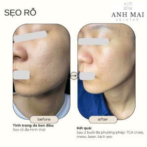 H&igrave;nh ảnh thực tế Before – After Sẹo