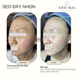 H&igrave;nh ảnh thực tế Before – After Sẹo